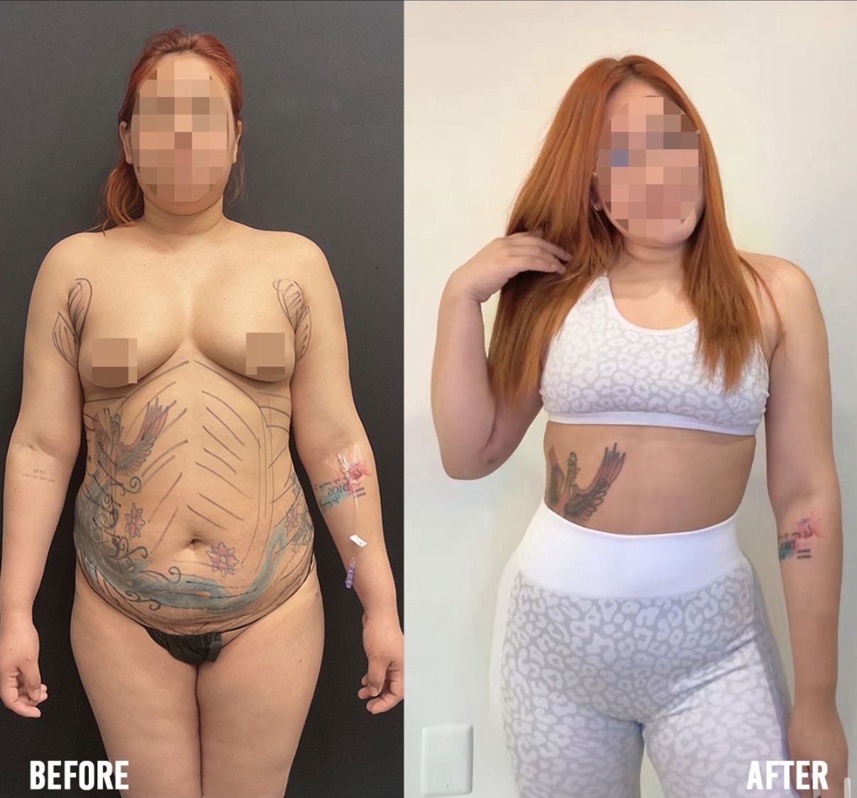 Tummy Tuck case photograph by Dr. Ronald Espinoza