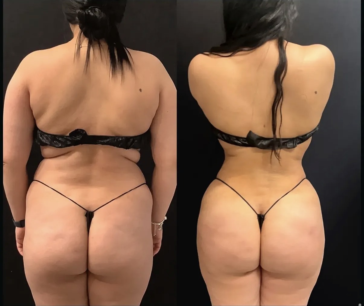 Brazilian Butt Lift case photograph by Dr. Ronald Espinoza