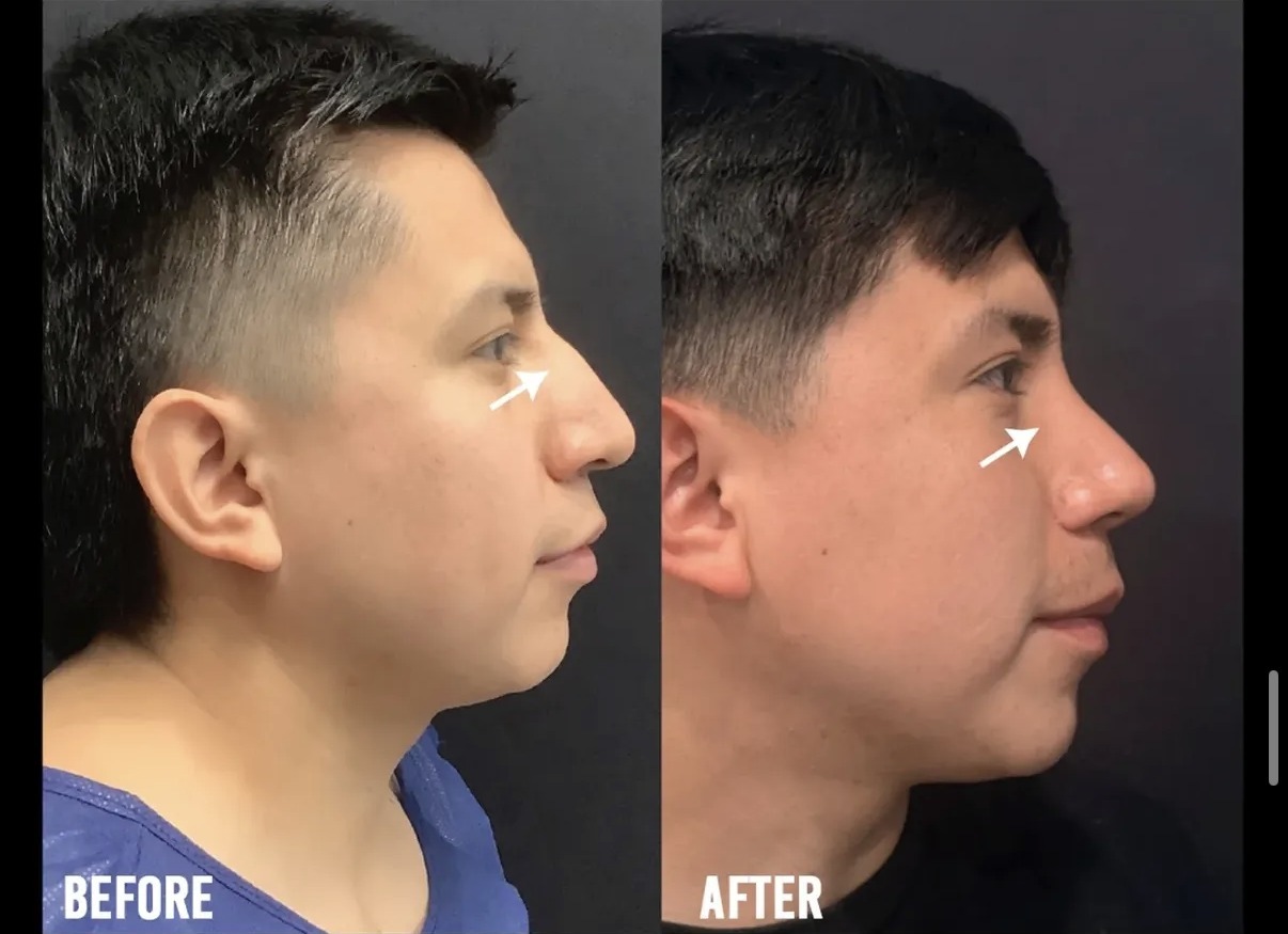 Rhinoplasty case photograph by Dr. Ronald Espinoza