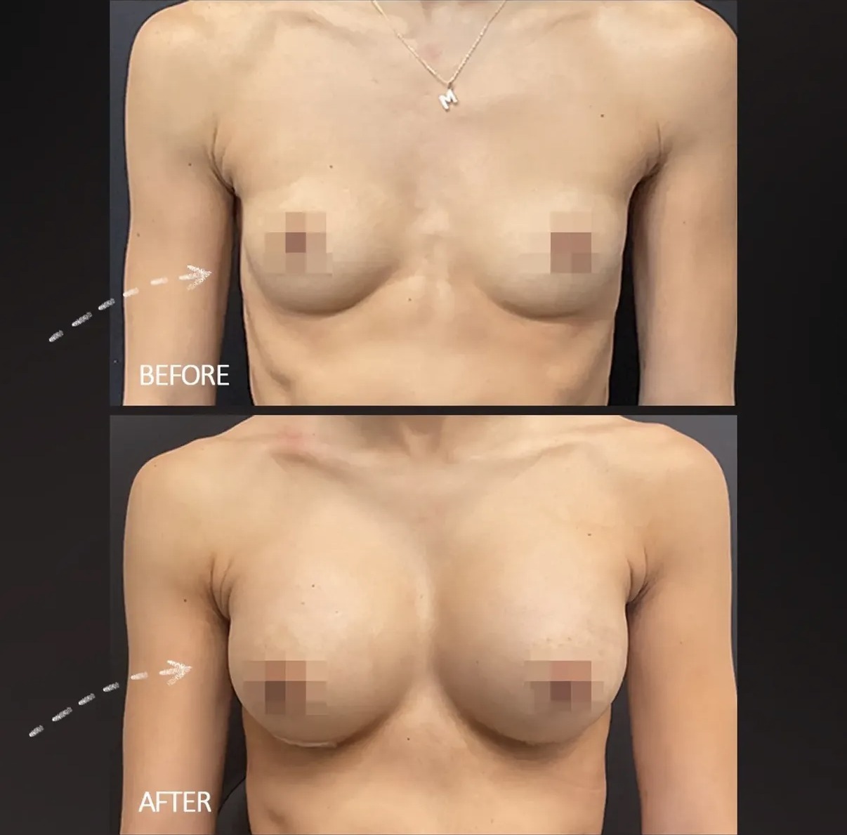 Breast Augmentation case photograph by Dr. Ronald Espinoza