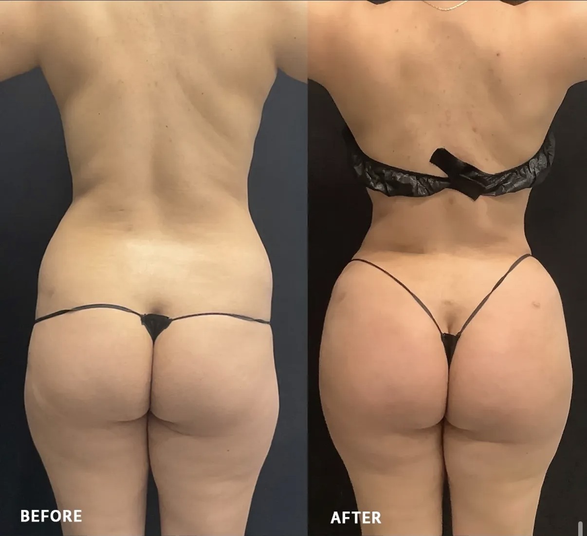 Mommy Makeover case photograph by Dr. Ronald Espinoza